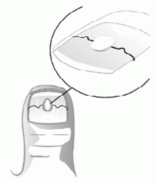 Eingewachsenen Nägel ? - Wellness Gesundheit - Györ